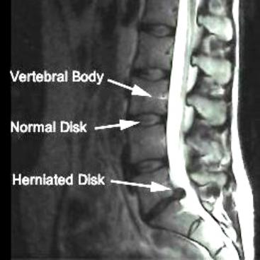Spine MRI Herniated Disc تشخیص بیرون زدگی دیسک کمر